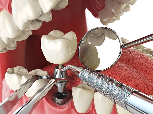 Best Emergency Root Canal Treatment in New Union, TN